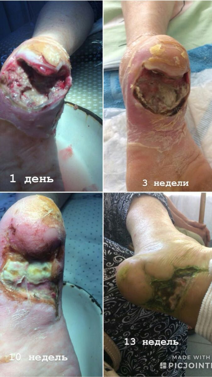 foot gangrene