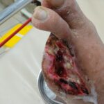 Nach Amputation von 2 extremen Fingern am linken Fuß. Gangrän