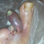 gangrene began on the 2nd toe of the left foot