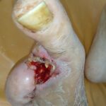 cut off 2 fingers on the left foot